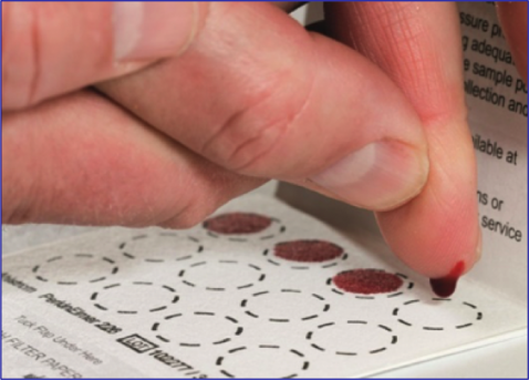 Abb. 2: Trockenblutkarte zur Morbus Fabry-Diagnostik